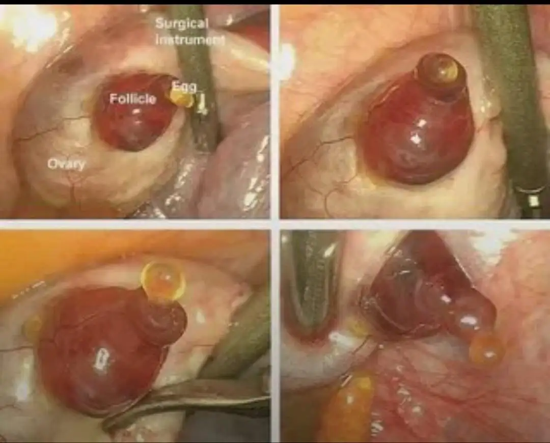 6i3utgl3vdpe1.jpeg 카메라에 포착된 희귀한 인간 난자