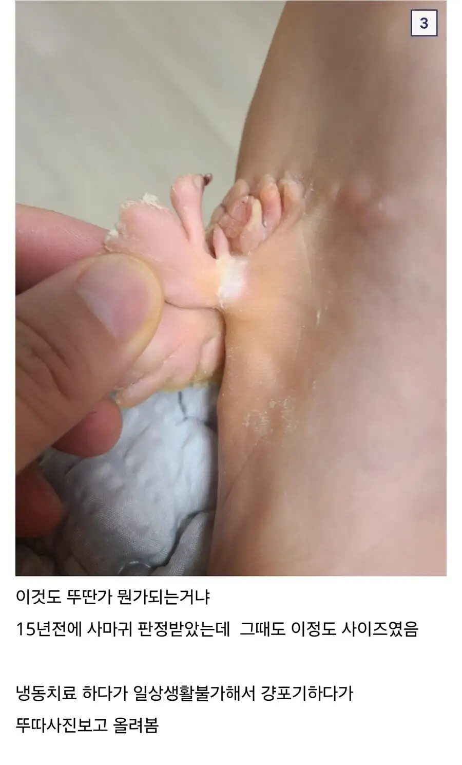 혐) 티눈갤 전설 도래창 사마귀_2.webp
