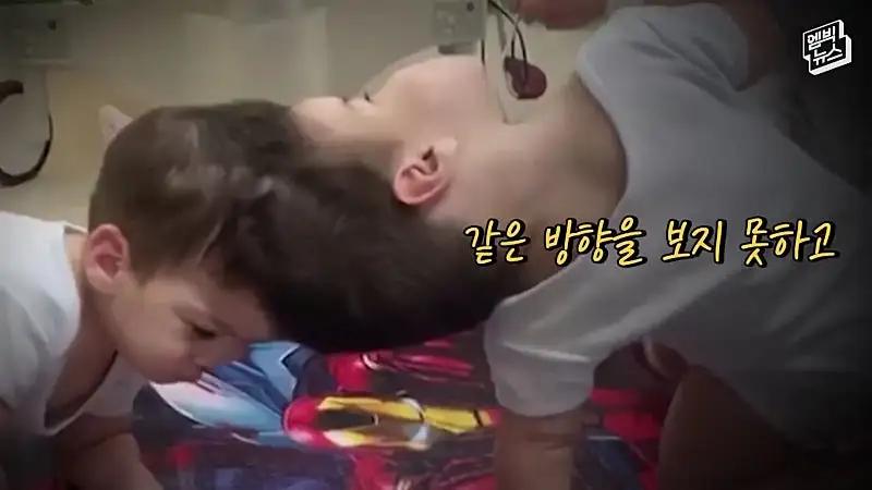 33시간 수술 끝에 얼굴 본 쌍둥이.jpg